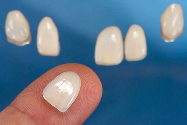 Dental veneers