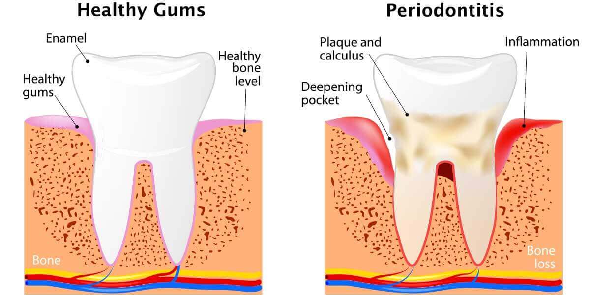 Healthy Gums vs Periodontitis disease diagram