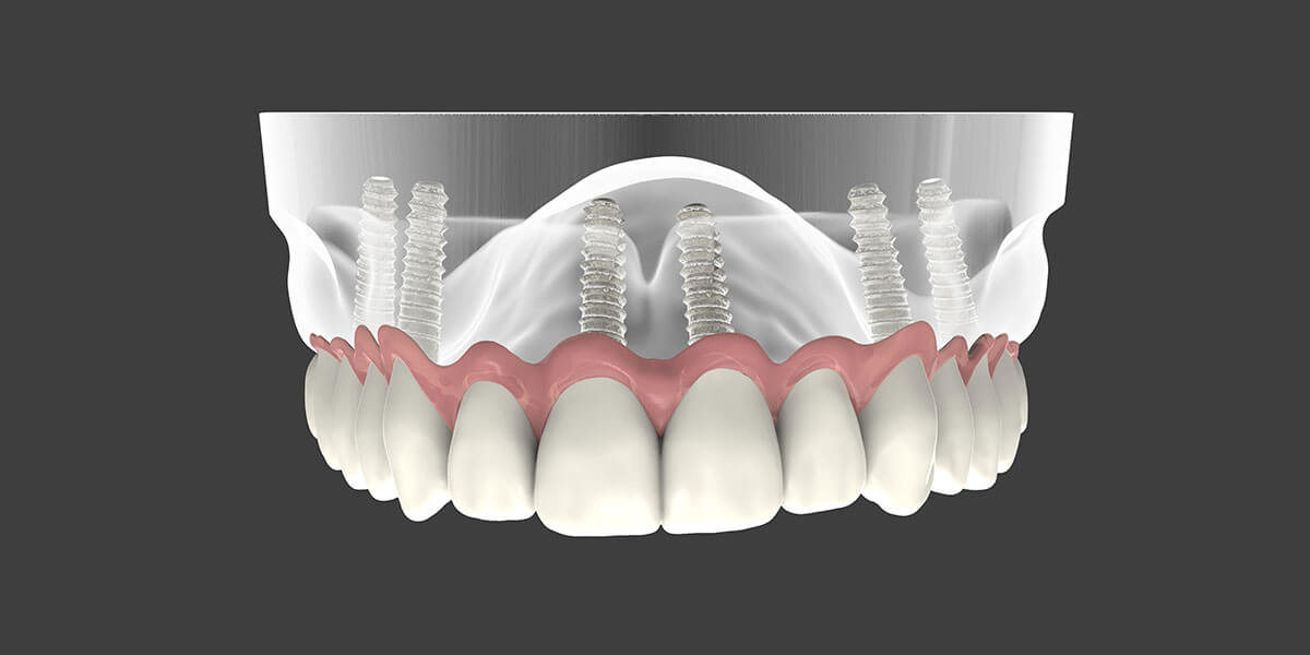 Tmj/tmd Treatment In Fort Walton Beach, Fl