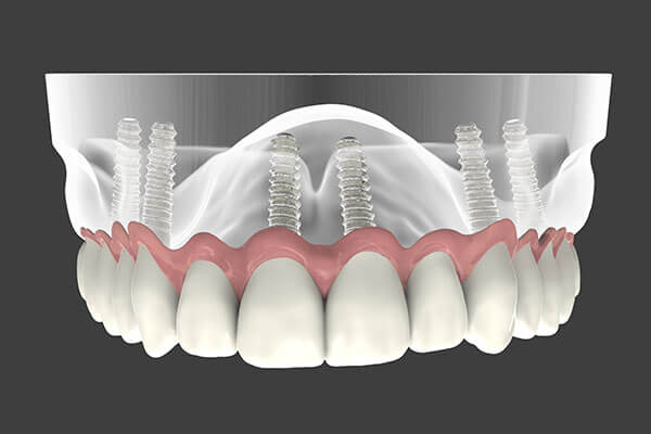 Implant supported dentures 3D rendering