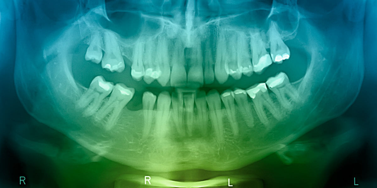 Dental x ray technology