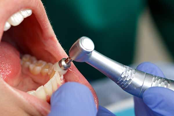 Person with their mouth open during a teeth cleaning