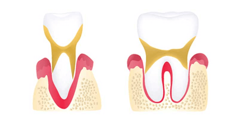 Advanced periodontitis diagram