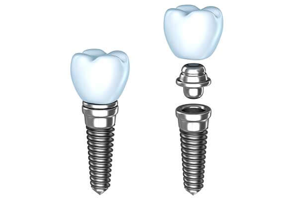 Single tooth dental implants diagram