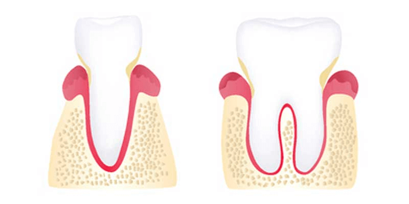 Early periodontitis diagram