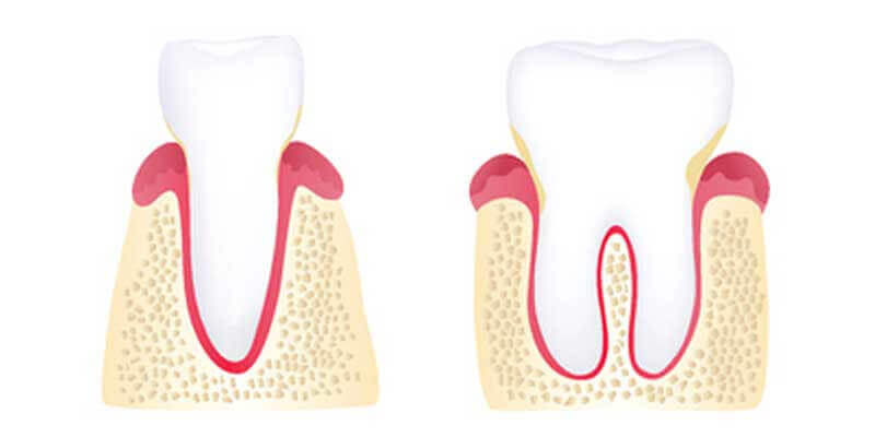 Gingivitis diagram