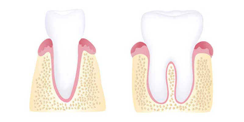 Healthy gums diagram