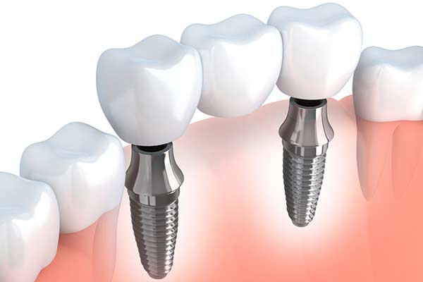 Implant supported dental bridge diagram
