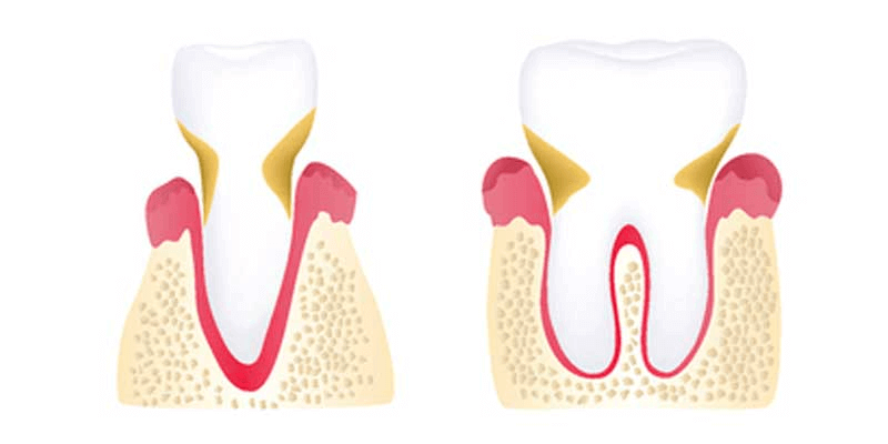 Moderate periodontitis diagram