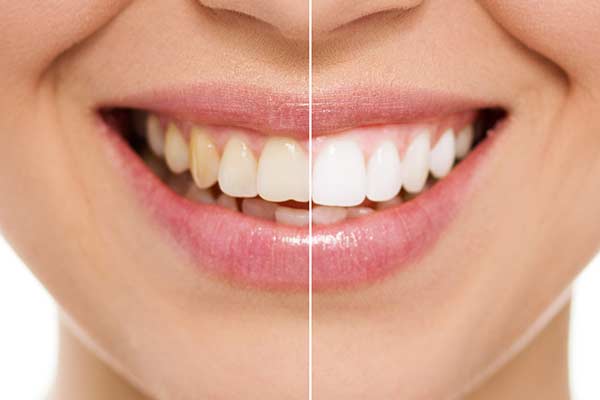 Teeth whitening before and after with a female patient